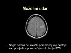 Moždani udar
