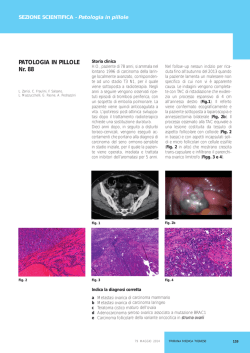 Carcinoma follicolare della variante oncocitica in struma ovarii