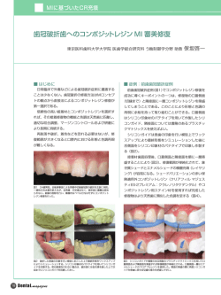 歯冠破折歯へのコンポジットレジン MI 審美修復