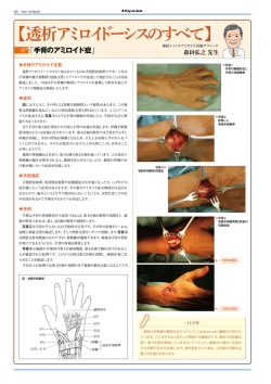 手背のアミロイド症 - 森田シャントアミロイド治療クリニック