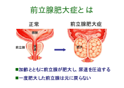 前立腺肥大症とは