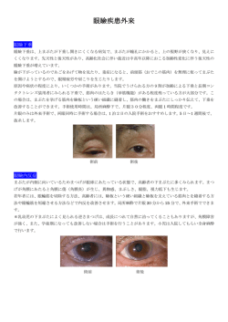 眼瞼疾患外来