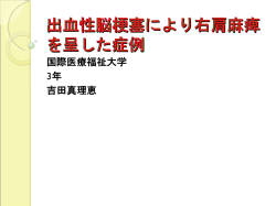 出血性脳梗塞により右肩麻痺 を呈した症例