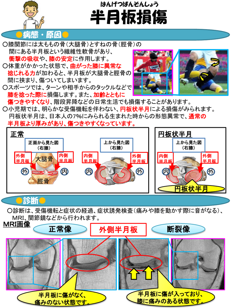 半月板損傷