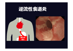 逆流性食道炎［PDF］