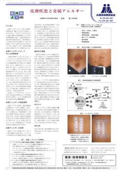 皮膚疾患と金属アレルギー