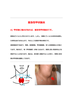 亜急性甲状腺炎です。