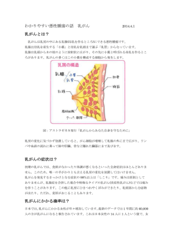 わかりやすい悪性腫瘍の話 乳がん 乳がんとは？ 乳がんの症状は