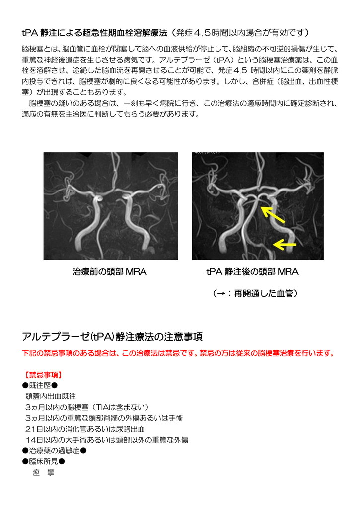 アルテプラーゼ Tpa 静注療法の注意事項