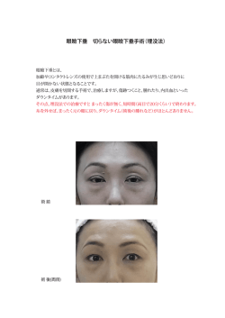 眼瞼下垂 切らない眼瞼下垂手術（埋没法）