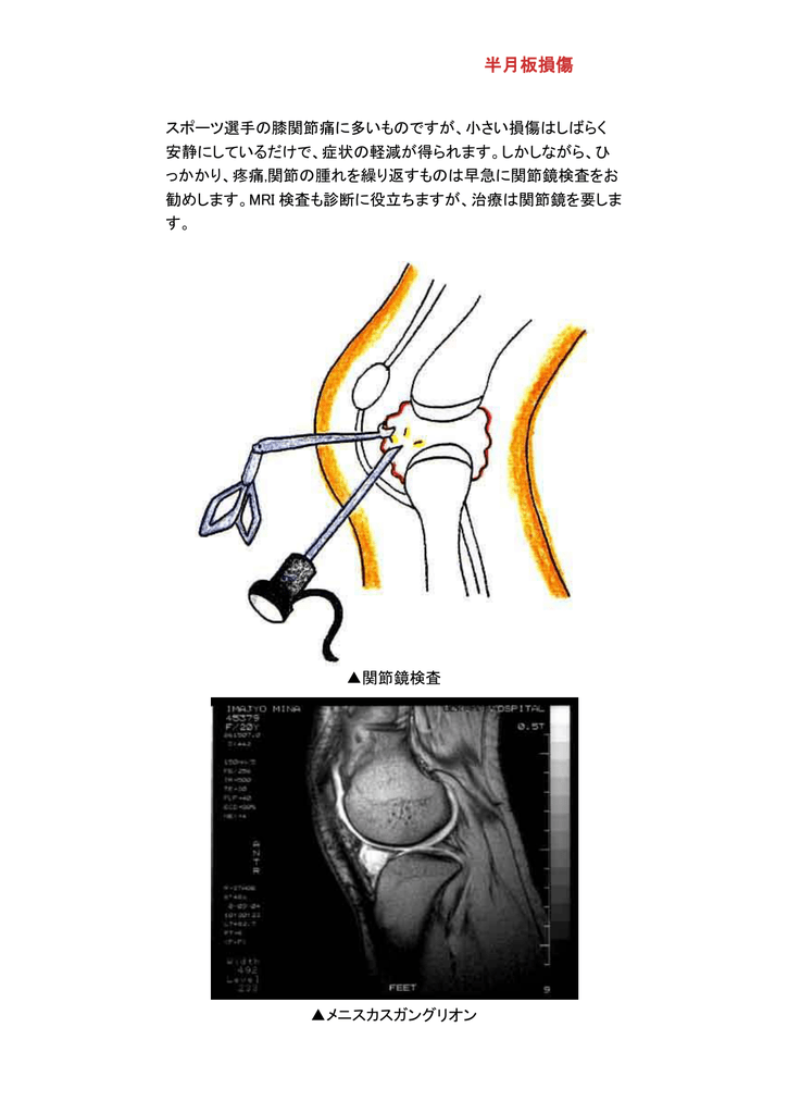 半月板損傷