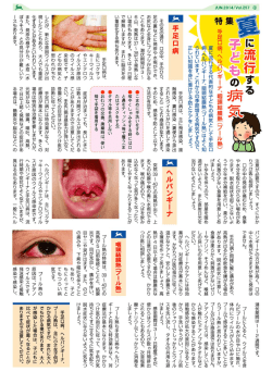特 手足口病、ヘルパンギーナ、咽頭結膜熱(プール熱)