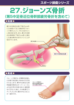 27-ジョーンズ骨折