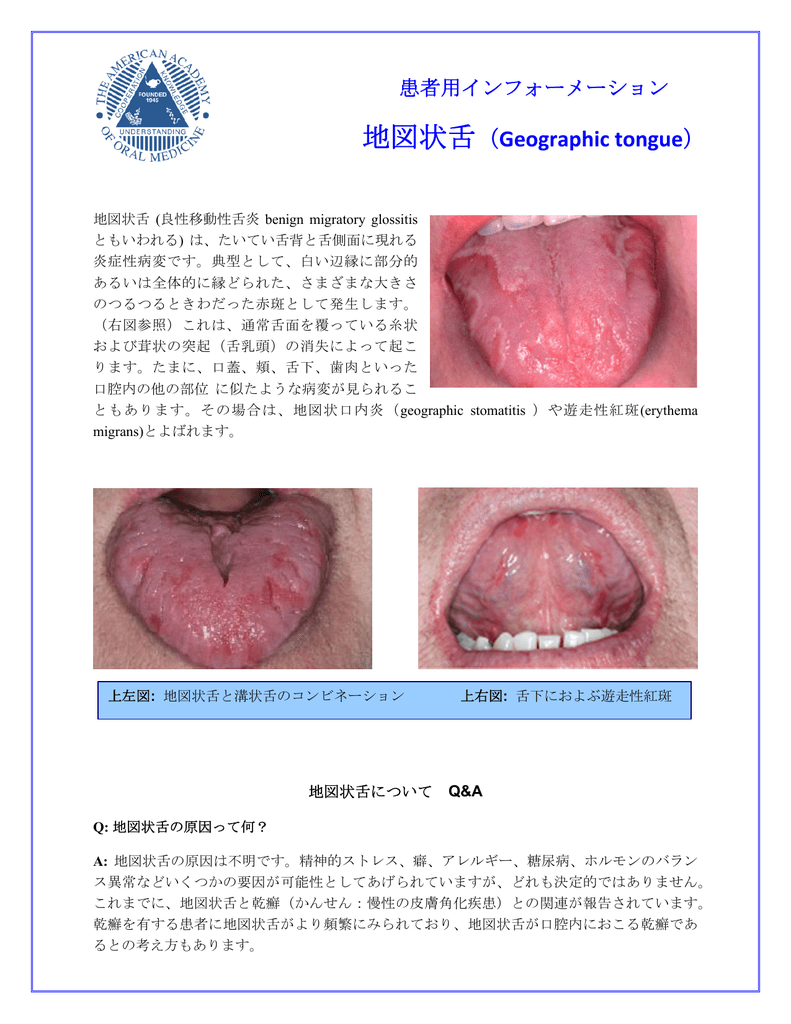 Geographic Tongue The American Academy Of Oral Medicine
