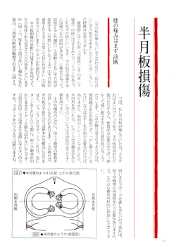 半月板損傷