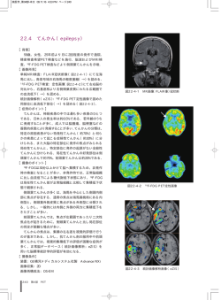 22.4 てんかん（epilepsy）
