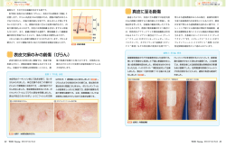 真皮に至る創傷 表皮欠損のみの創傷（びらん）