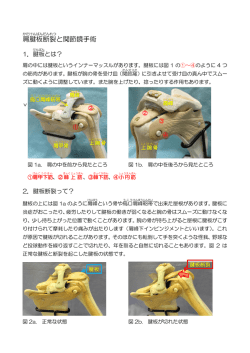 肩腱板断裂 と関節鏡手術