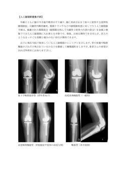 【人工膝関節置換手術】 年齢とともに膝の半月板や軟骨がすり減り、膝に