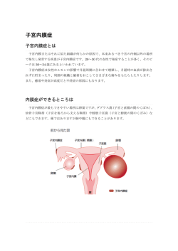 子宮内膜症 - 横浜市立市民病院