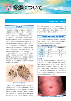 特集2：疥癬について