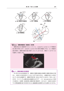 僧帽弁輪径の計測時相 次に考えるのは計測時相です．