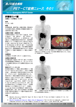 肝悪性リンパ腫 - 浅ノ川総合病院