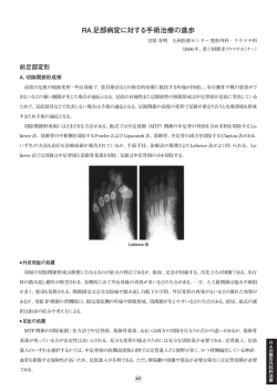 RA 足部病変に対する手術治療の進歩
