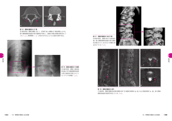 図 18 腰椎分離症の MRI 16 歳男性，腰椎分離症急性期の腰椎 MRI T2