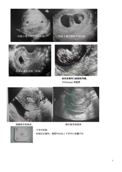 妊娠5週2卵性双胎妊娠 妊娠8週2卵性双胎妊娠 妊娠8週枯死
