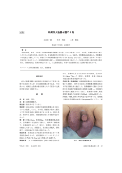 両側巨大陰嚢水腫の1例