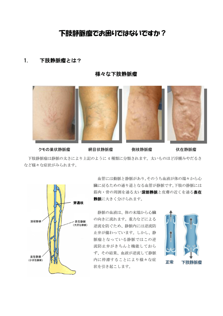下肢静脈瘤について