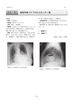 胸部単純 X-P での巨大なニボー像