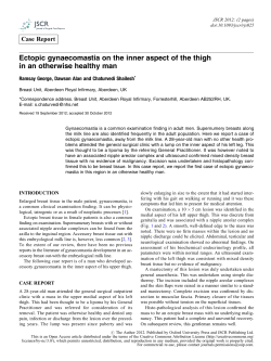 Ectopic gynaecomastia on the inner aspect of the