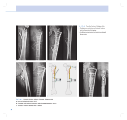 26 Fig. 2-3a&ndash;b Complex fracture. Bridging plate. a Gentle open