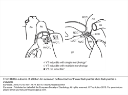 Better outcome of ablation for sustained outflow