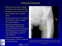 (arrow) Axial image demonstrating the radiolucent nidus