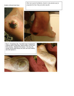 Diabetic Infected Heel Ulcer After last round of antibiotics. Doctor`s