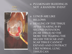 PULMONARY BLEEDING IS NOT A RANDOM EVENT LUNGsARE