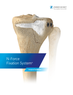 N-Force Fixation System&reg; Surgical Technique