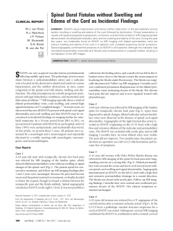 Spinal Dural Fistulas without Swelling and Edema of the Cord as