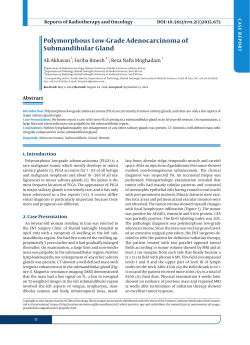 Polymorphous Low-Grade Adenocarcinoma of Submandibular Gland