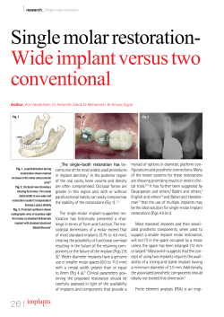 26-30 Single molar restoration- Wide implant versus two conventional