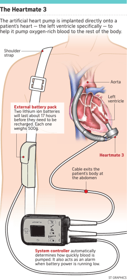 The Heartmate 3 - The Straits Times