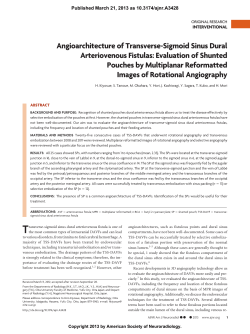 Angioarchitecture of Transverse-Sigmoid Sinus Dural Arteriovenous