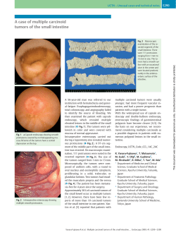 A case of multiple carcinoid tumors of the small intestine