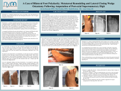 A Case of Bilateral Foot Polydactly
