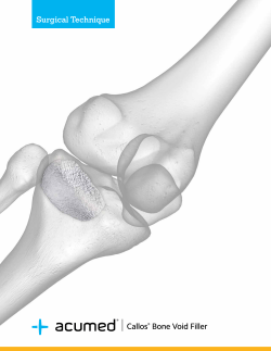 Acumed Callos Bone Void Filler Surgical Technique