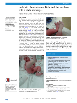 Harlequin phenomenon at birth: and she was born with a white
