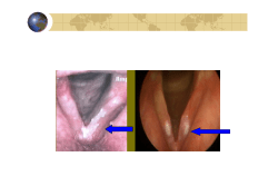 Laryngeal leukoplakia